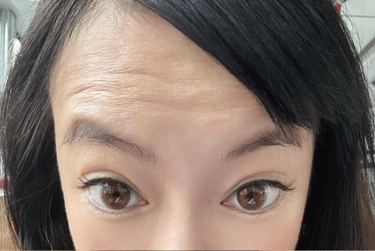 ❤肉毒療程分享❤ 輕齡小資美學診所