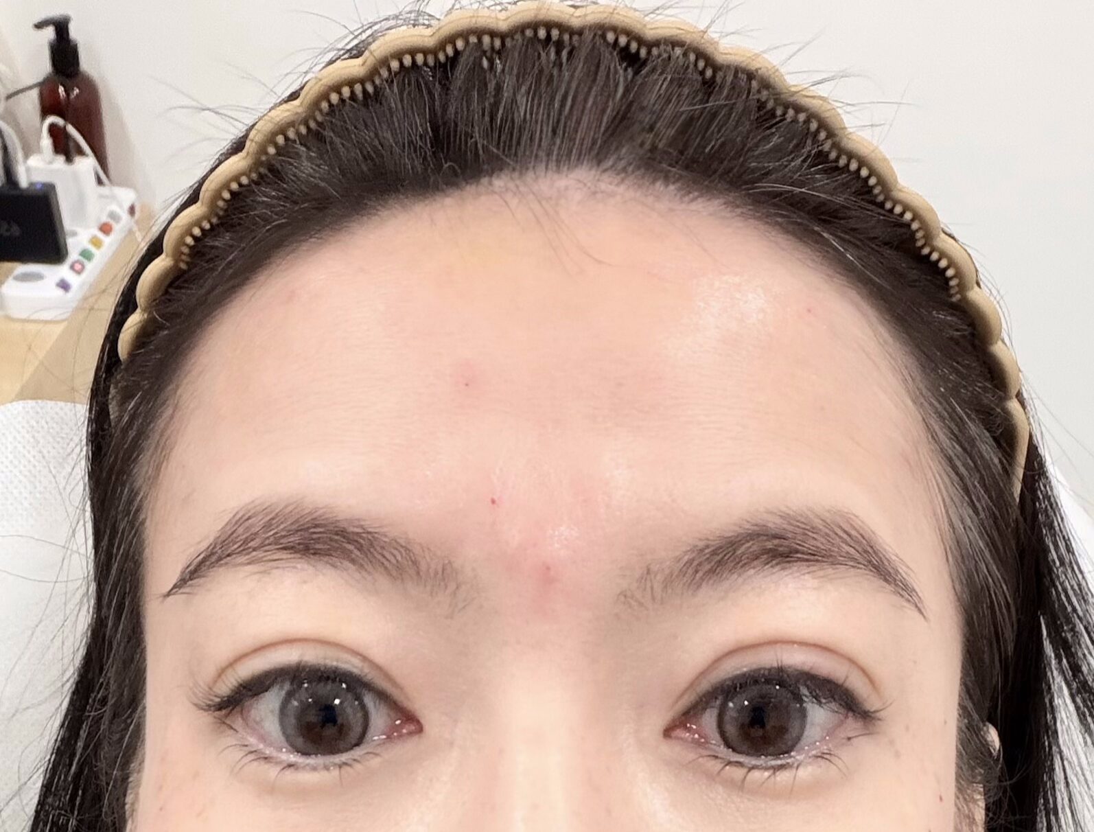 ❤肉毒療程分享❤ 輕齡小資美學診所